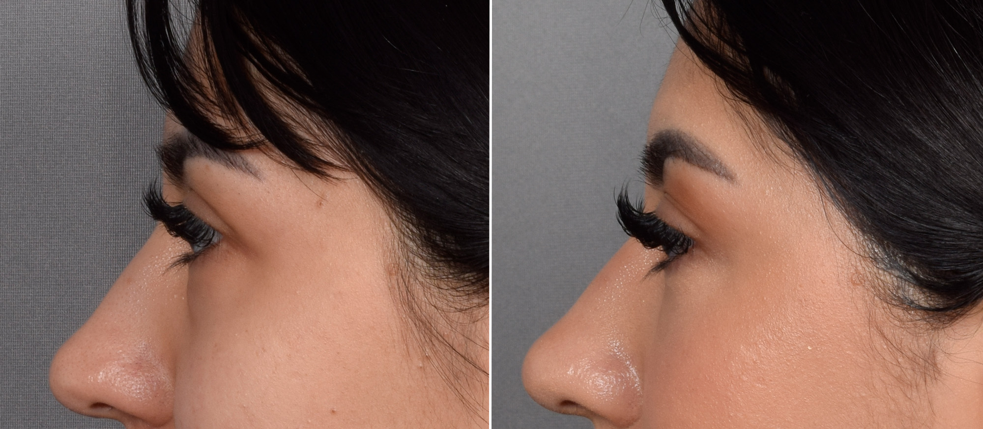 CO2 Laser Before & After Gallery - Patient 318014 - Image 11