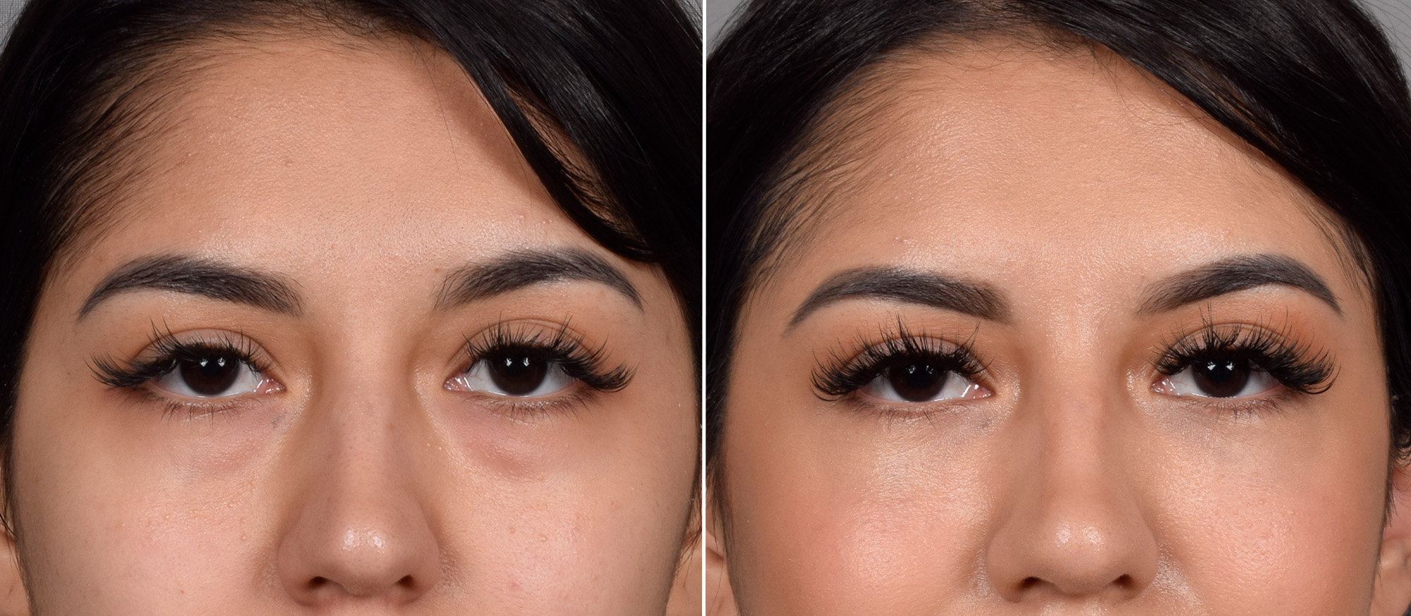 CO2 Laser Before & After Gallery - Patient 318014 - Image 6