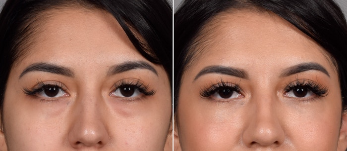 Lower Blepharoplasty Before & After Gallery - Patient 235925 - Image 1