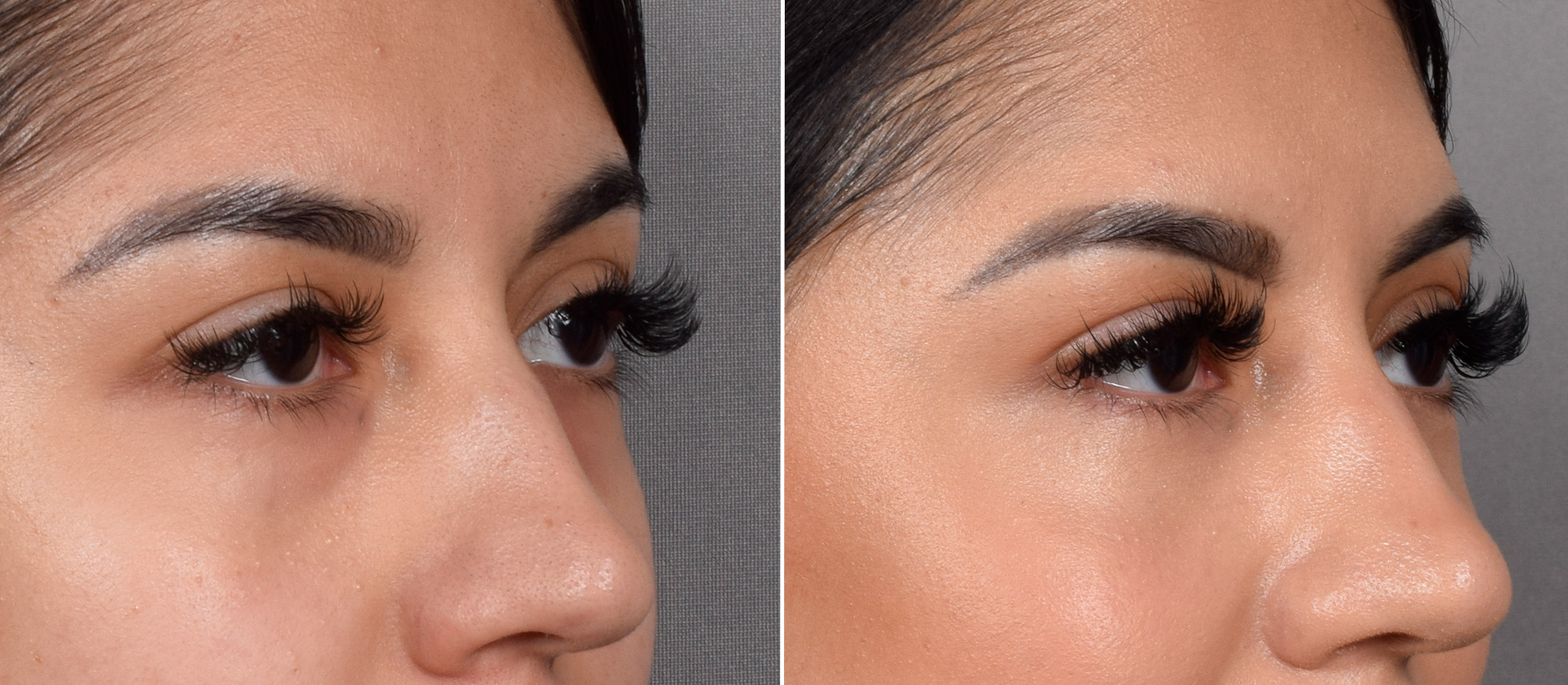 CO2 Laser Before & After Gallery - Patient 318014 - Image 8