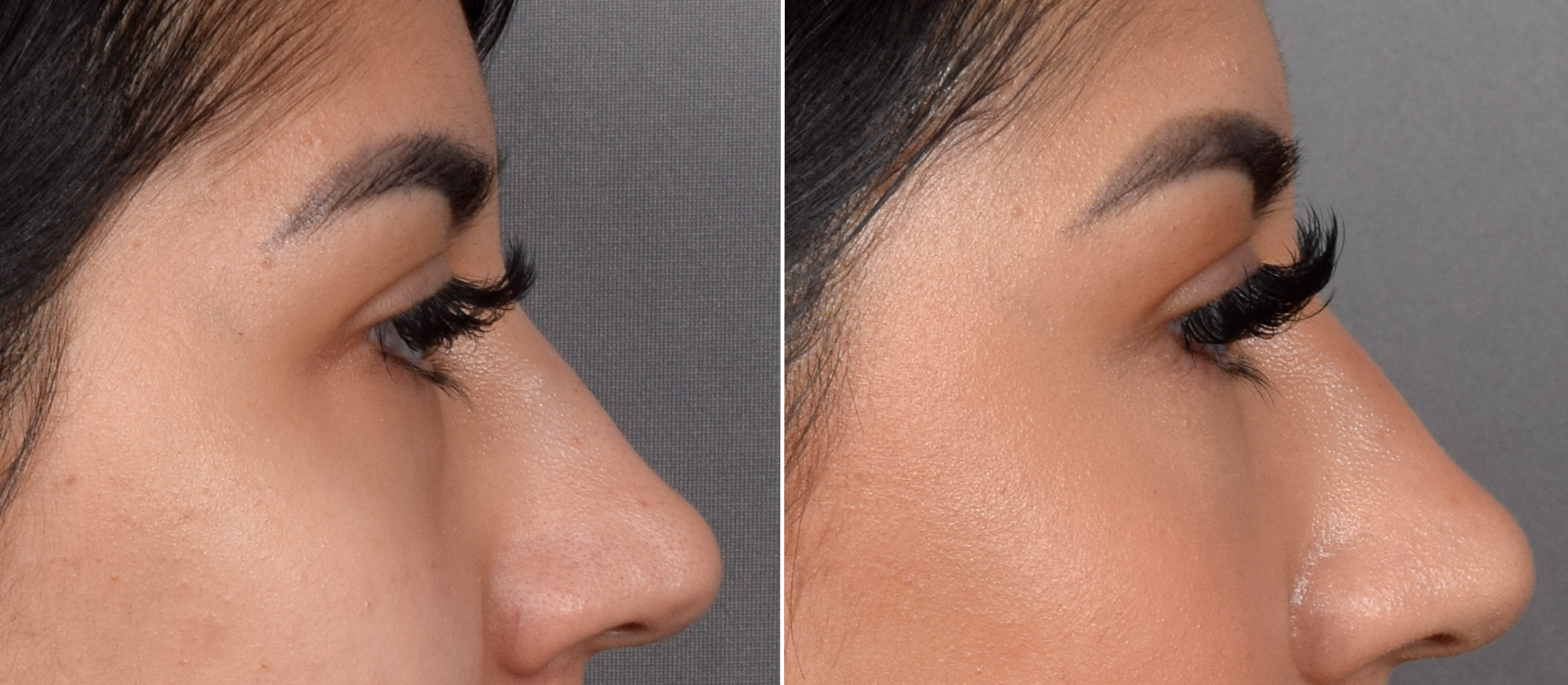 CO2 Laser Before & After Gallery - Patient 318014 - Image 9