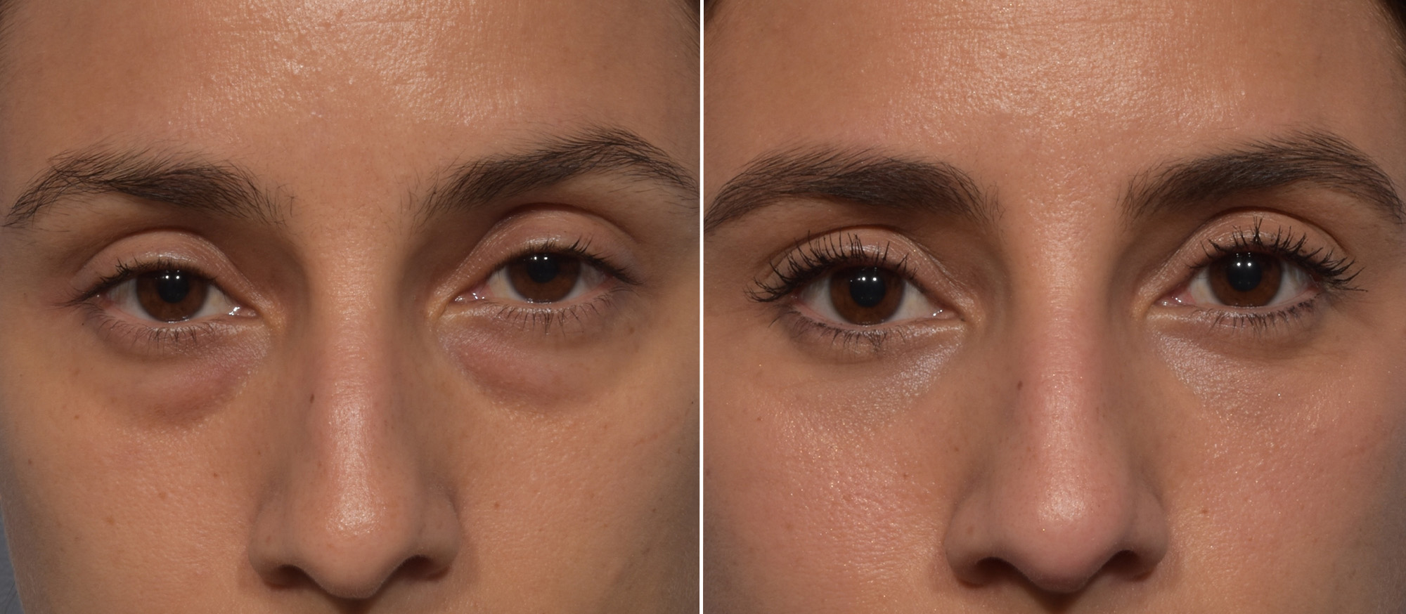 Lower Blepharoplasty Before & After Gallery - Patient 242044 - Image 1