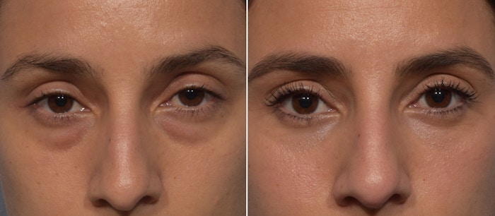 Lower Blepharoplasty Before & After Gallery - Patient 242044 - Image 1