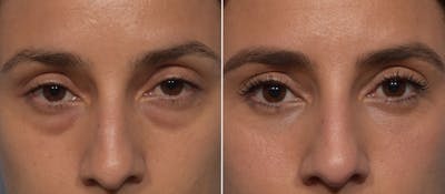 Lower Blepharoplasty Before & After Gallery - Patient 242044 - Image 1