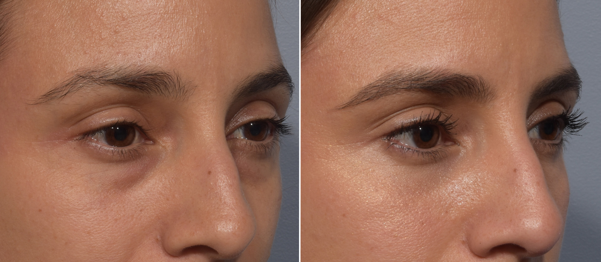 Lower Blepharoplasty Before & After Gallery - Patient 242044 - Image 2