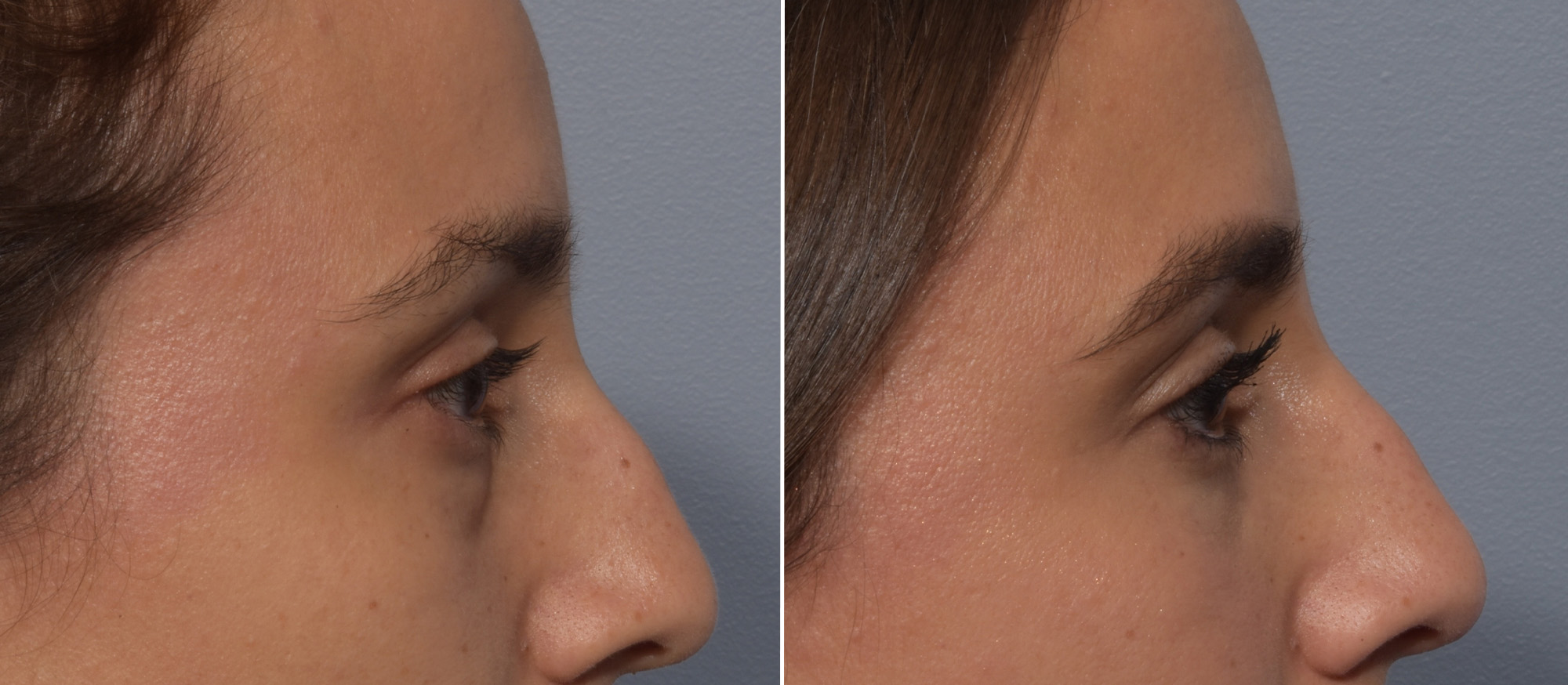 Lower Blepharoplasty Before & After Gallery - Patient 242044 - Image 3