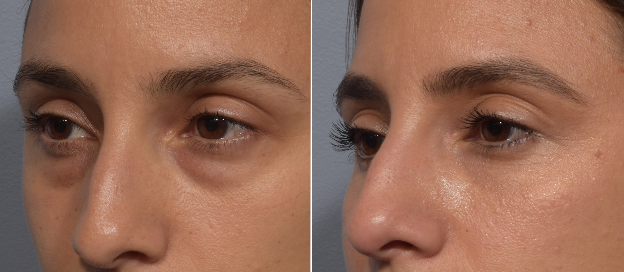 Lower Blepharoplasty Before & After Gallery - Patient 242044 - Image 4