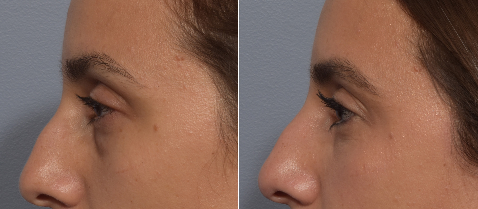 Lower Blepharoplasty Before & After Gallery - Patient 242044 - Image 5