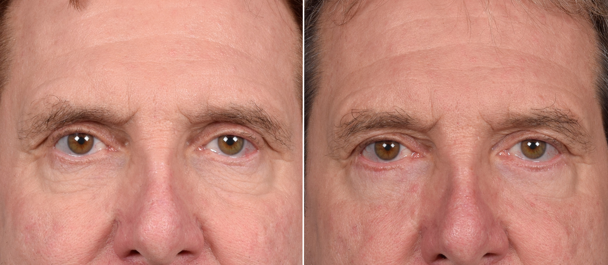 Lower Blepharoplasty Before & After Gallery - Patient 298773 - Image 1