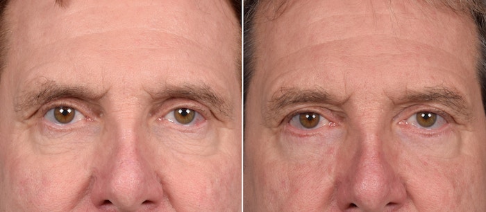 Lower Blepharoplasty Before & After Gallery - Patient 298773 - Image 1