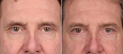 Lower Blepharoplasty Before & After Gallery - Patient 298773 - Image 1