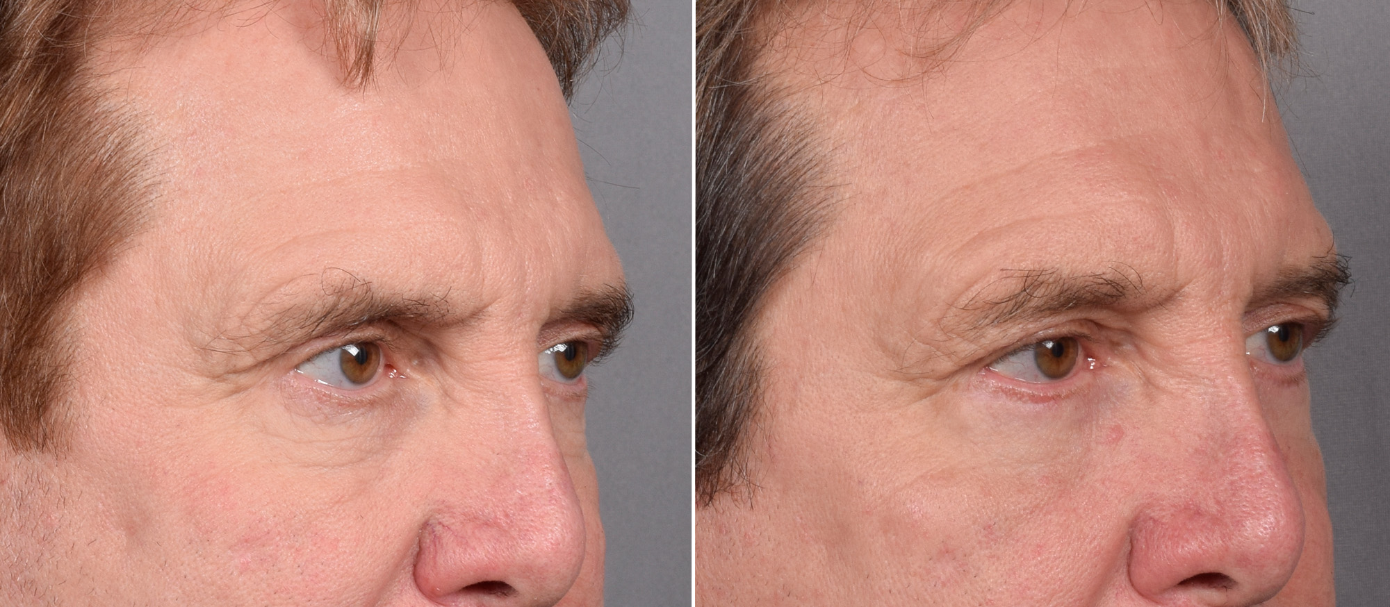 Lower Blepharoplasty Before & After Gallery - Patient 298773 - Image 2