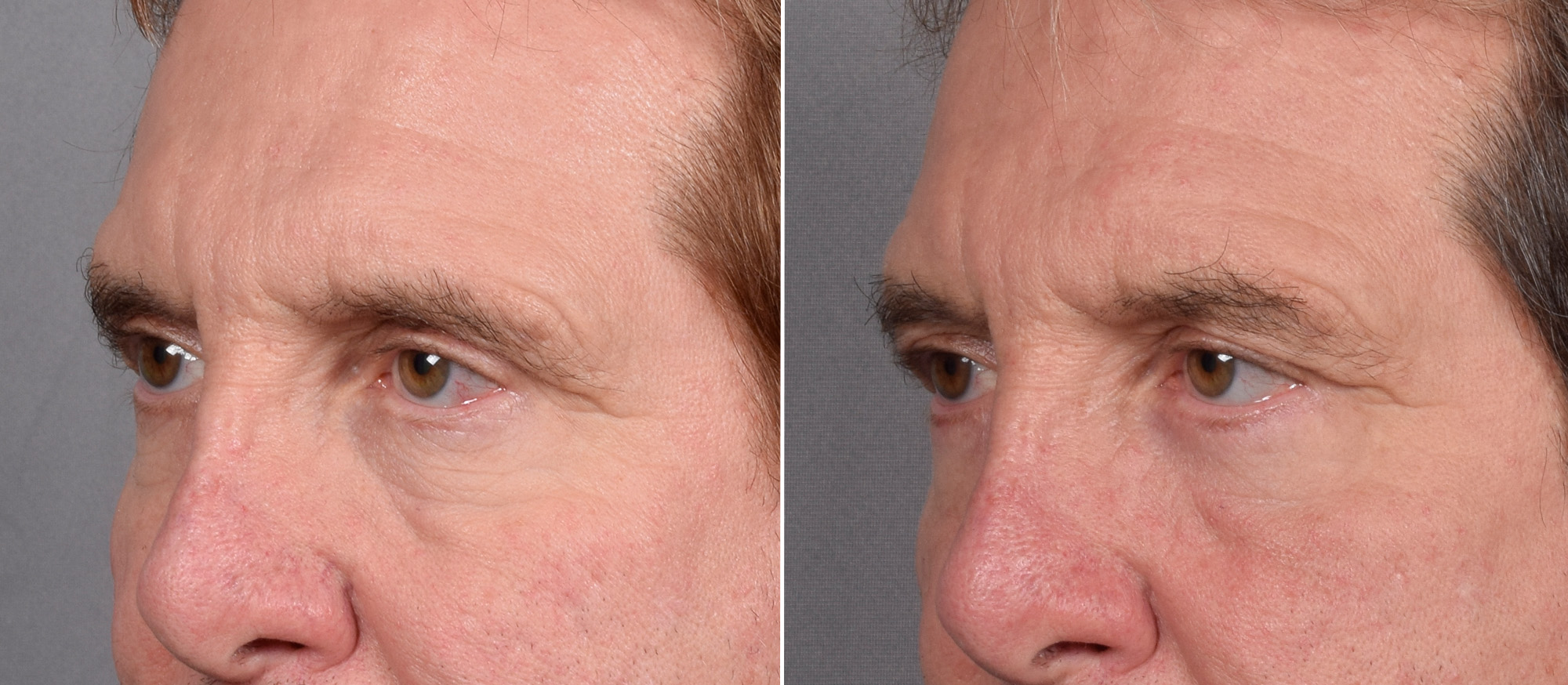 Lower Blepharoplasty Before & After Gallery - Patient 298773 - Image 3