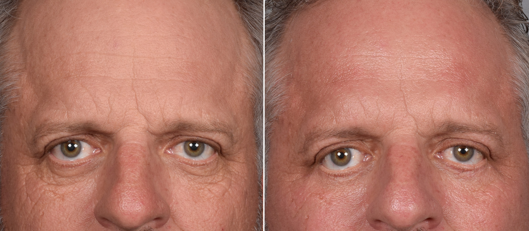 Lower Blepharoplasty Before & After Gallery - Patient 881397 - Image 1