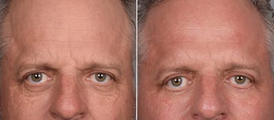 Lower Blepharoplasty Before & After Gallery - Patient 881397 - Image 1