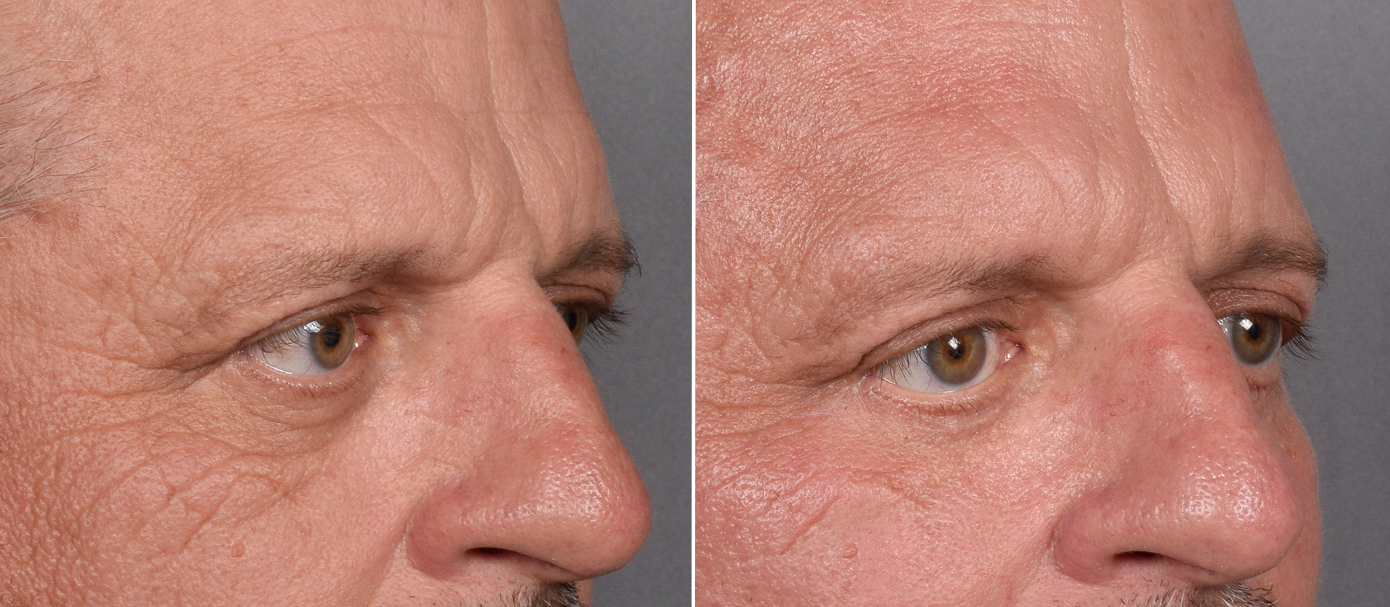 Lower Blepharoplasty Before & After Gallery - Patient 881397 - Image 2