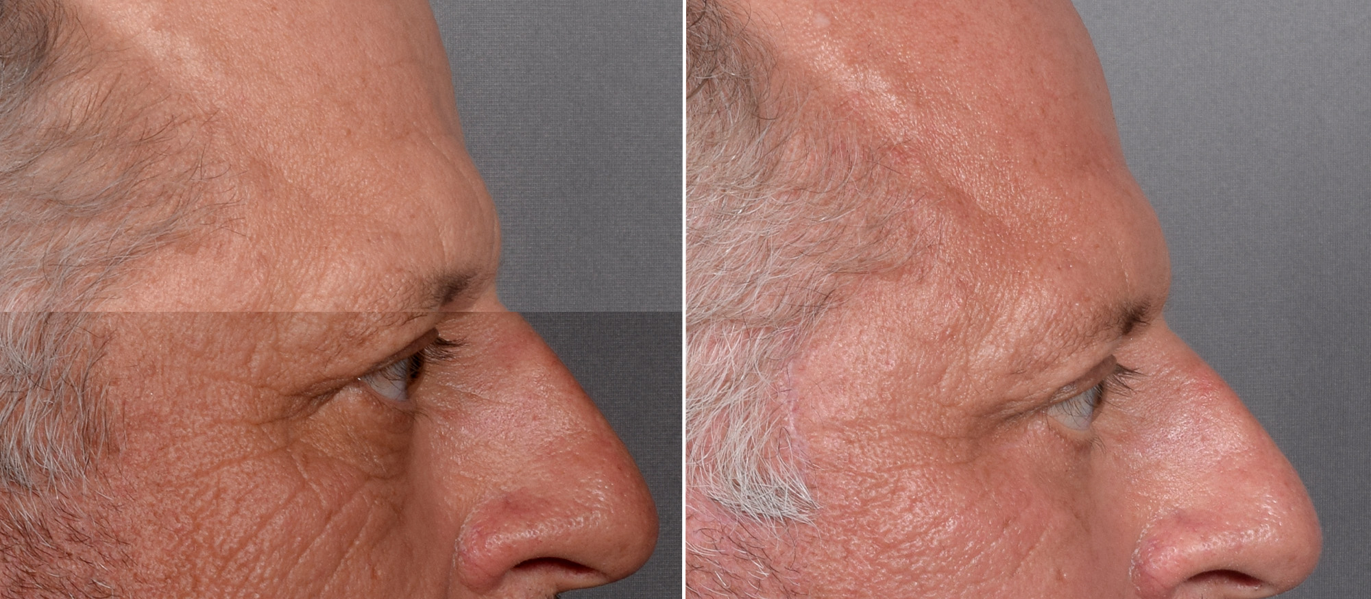 Lower Blepharoplasty Before & After Gallery - Patient 881397 - Image 3