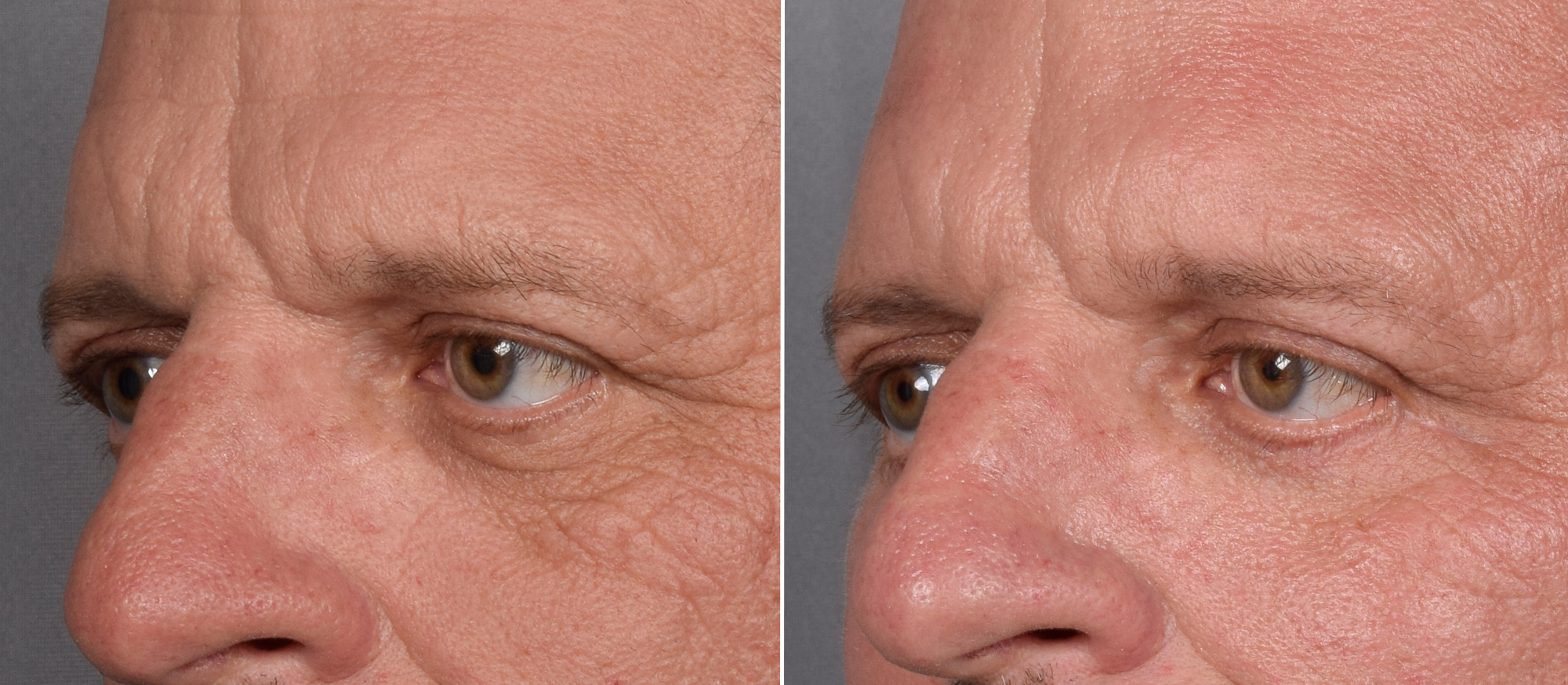 Lower Blepharoplasty Before & After Gallery - Patient 881397 - Image 4
