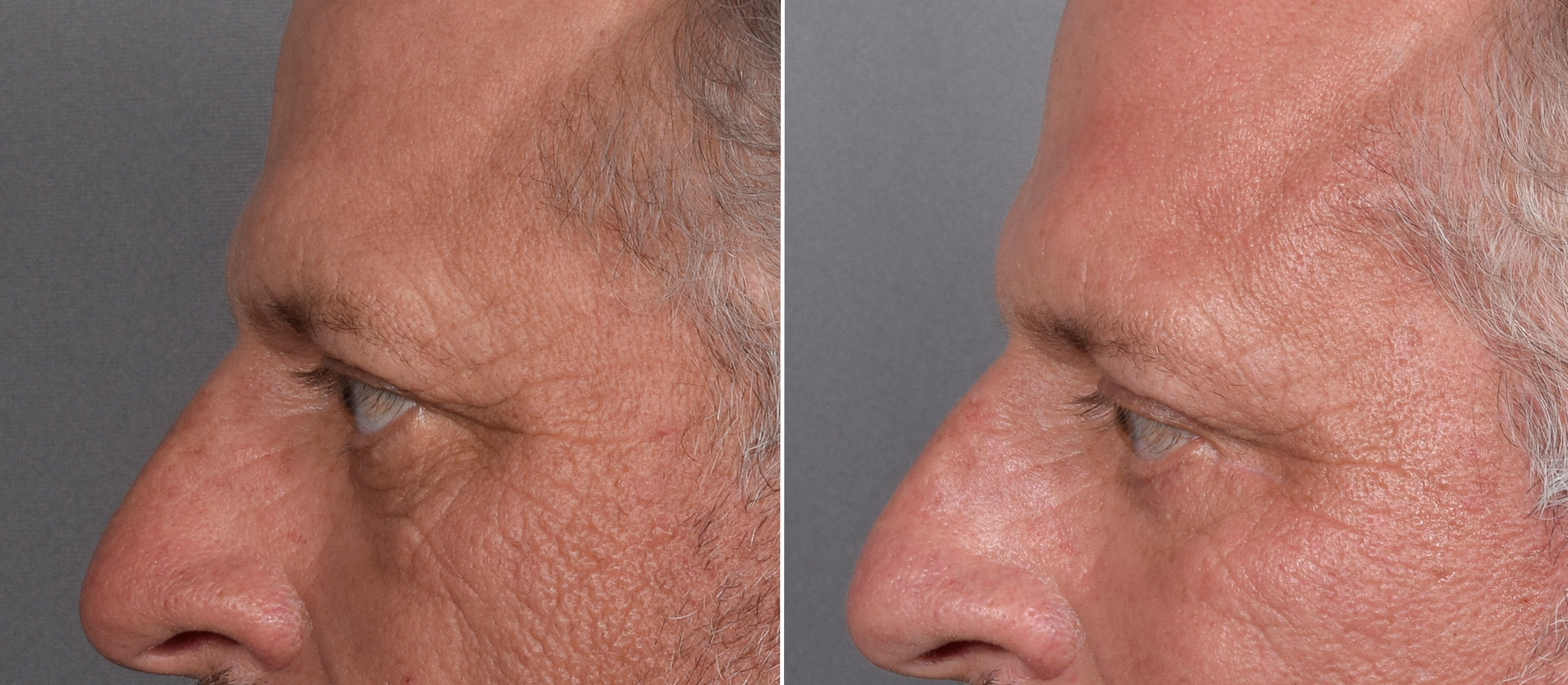 Lower Blepharoplasty Before & After Gallery - Patient 881397 - Image 5