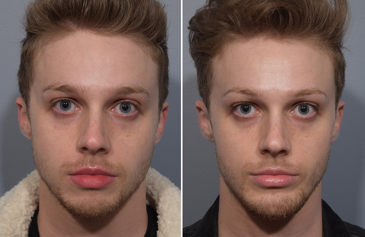 Chin Implant Before & After Gallery - Patient 212061 - Image 10