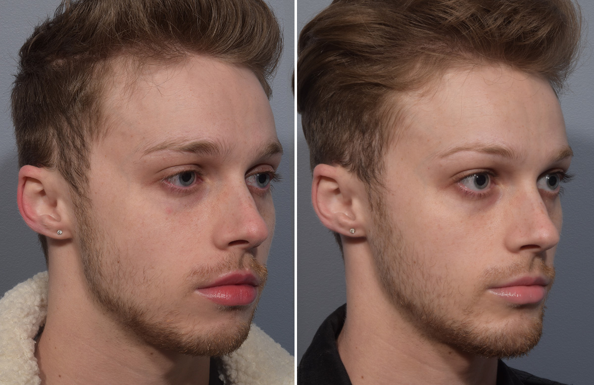 Chin Implant Before & After Gallery - Patient 212061 - Image 7