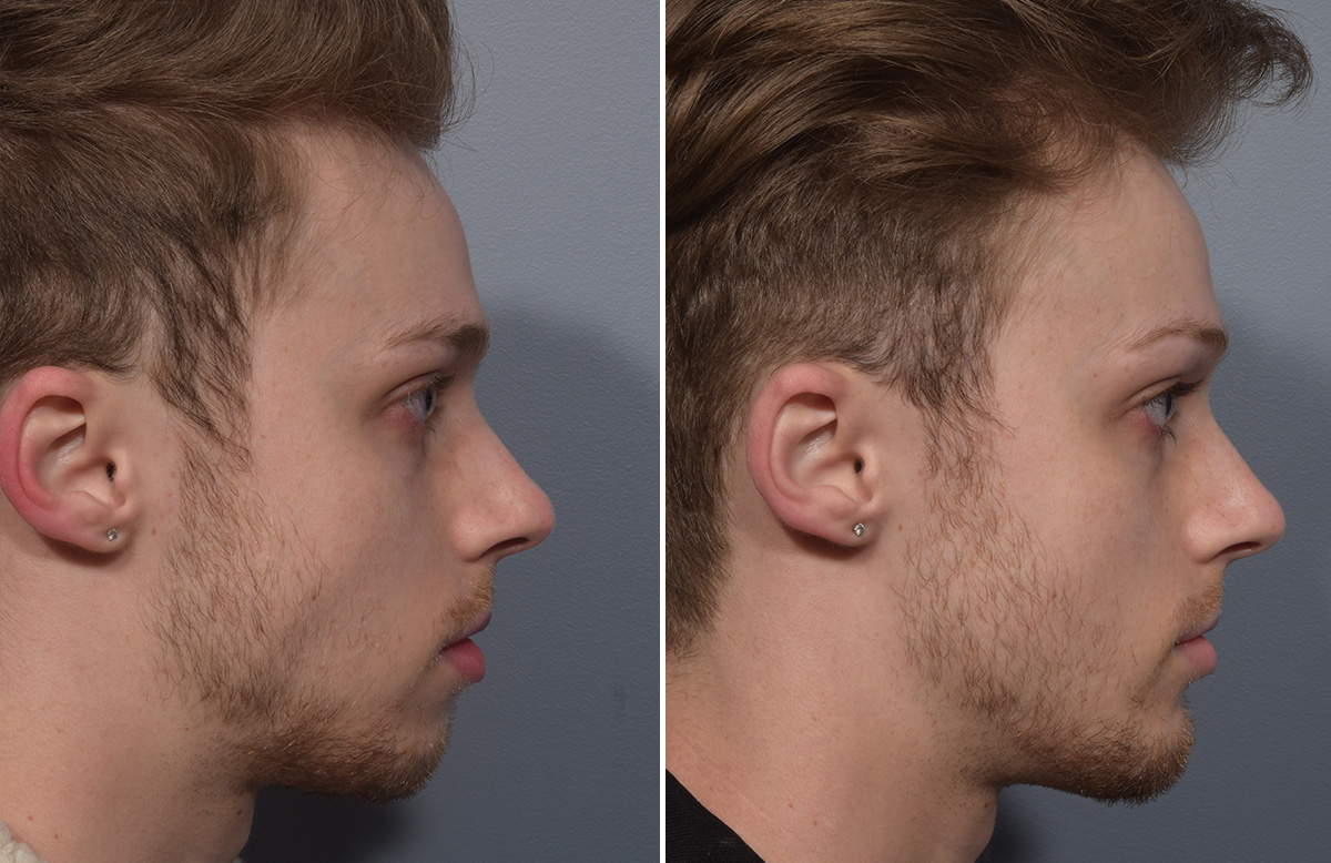 Chin Implant Before & After Gallery - Patient 212061 - Image 8