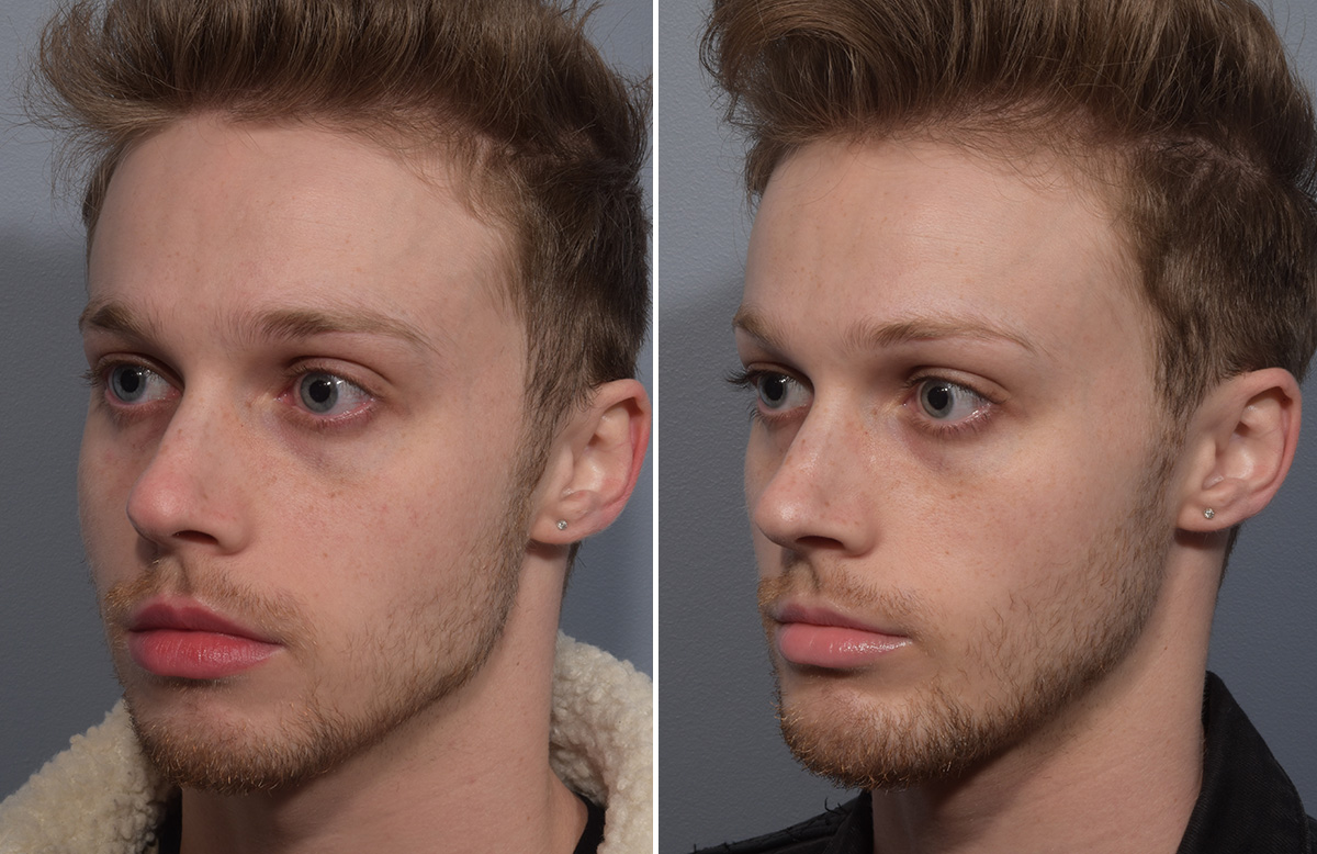 Chin Implant Before & After Gallery - Patient 212061 - Image 6