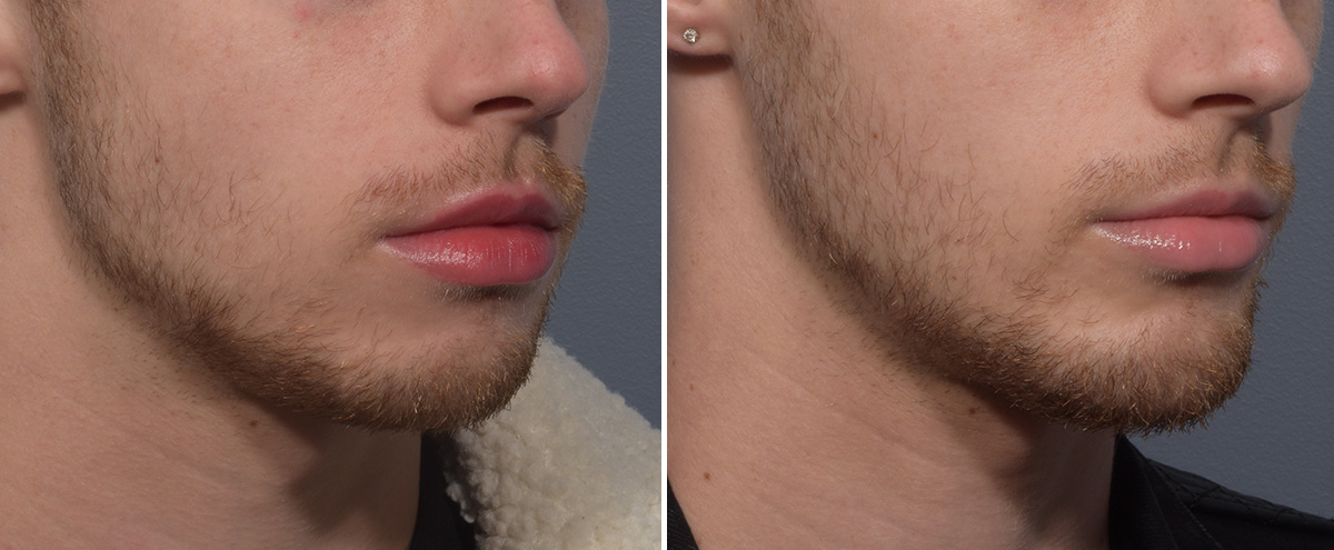 Chin Implant Before & After Gallery - Patient 212061 - Image 2
