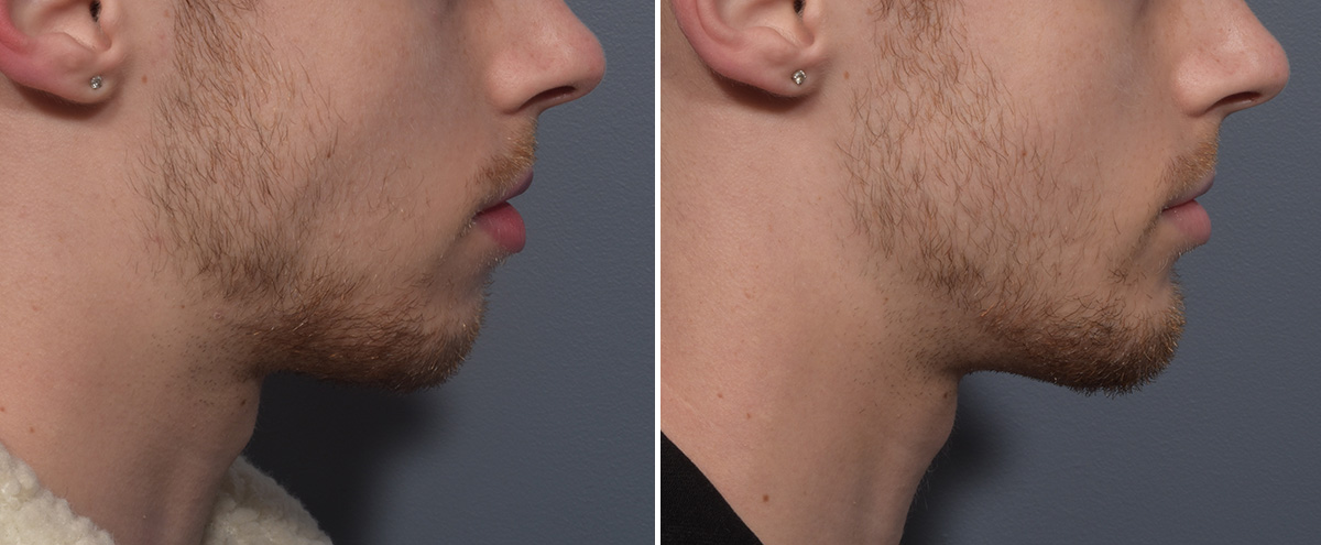 Chin Implant Before & After Gallery - Patient 212061 - Image 3