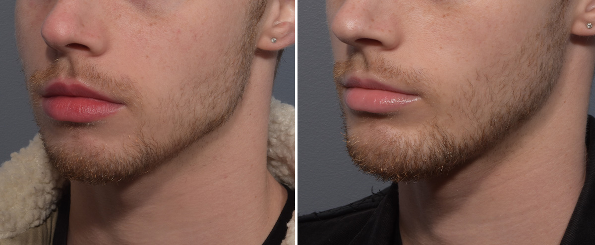 Chin Implant Before & After Gallery - Patient 212061 - Image 1