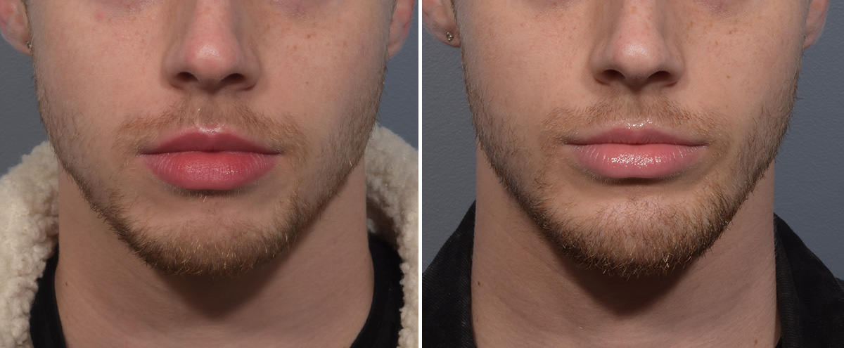 Chin Implant Before & After Gallery - Patient 212061 - Image 5