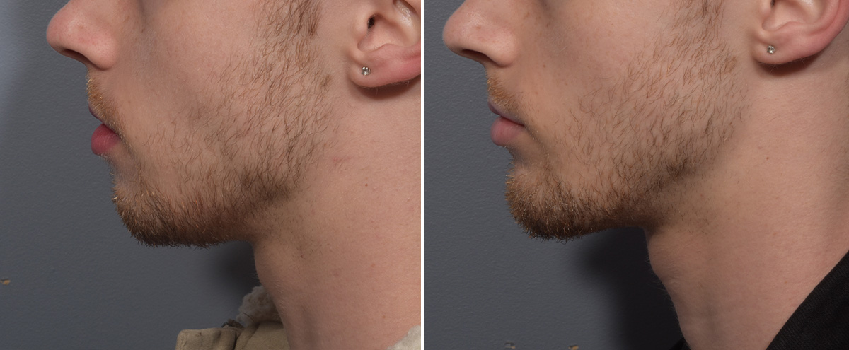 Chin Implant Before & After Gallery - Patient 212061 - Image 4