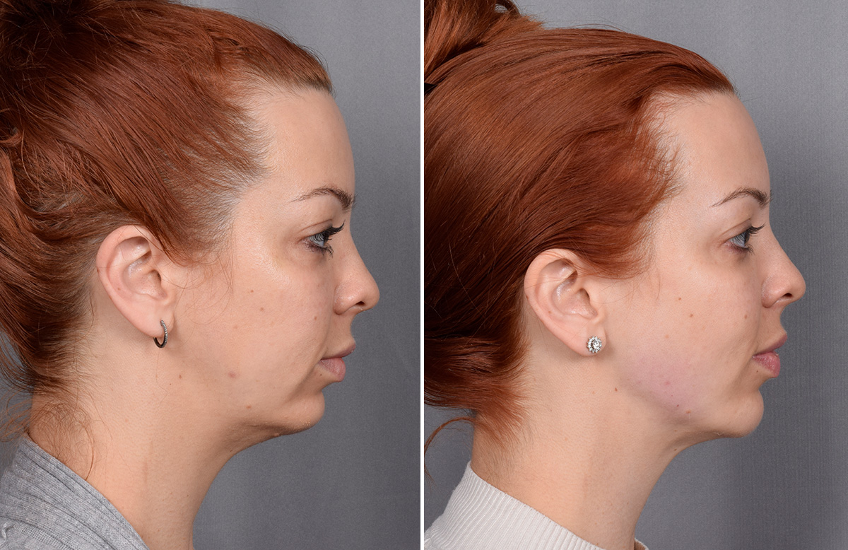 Chin Implant Before & After Gallery - Patient 382217 - Image 10