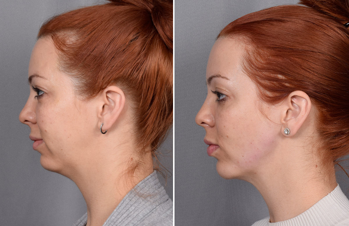 Chin Implant Before & After Gallery - Patient 382217 - Image 7