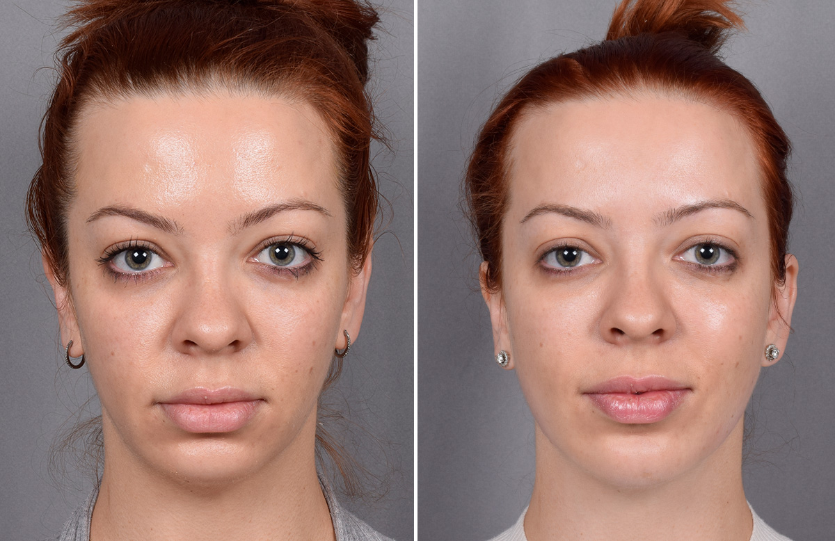 Chin Implant Before & After Gallery - Patient 382217 - Image 8