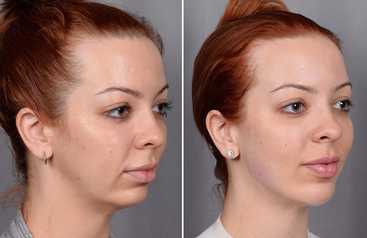 Chin Implant Before & After Gallery - Patient 382217 - Image 9