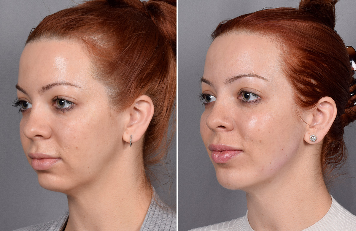 Chin Implant Before & After Gallery - Patient 382217 - Image 6