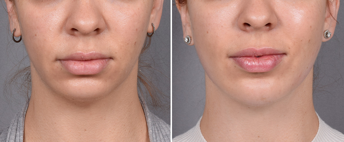 Chin Implant Before & After Gallery - Patient 382217 - Image 3