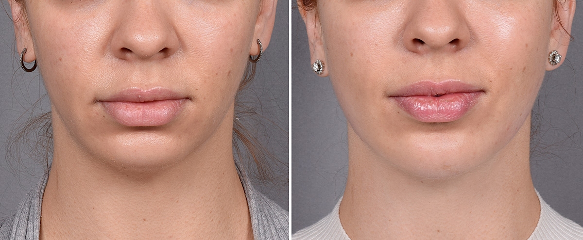 Chin Implant Before & After Gallery - Patient 382217 - Image 3