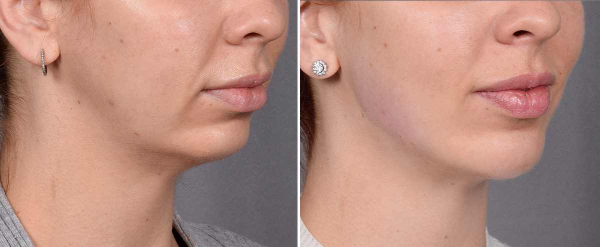 Chin Implant Before & After Gallery - Patient 382217 - Image 4