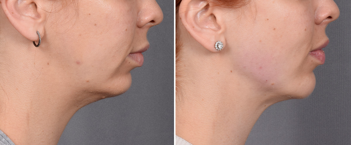 Chin Implant Before & After Gallery - Patient 382217 - Image 5