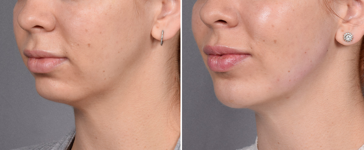 Chin Implant Before & After Gallery - Patient 382217 - Image 1