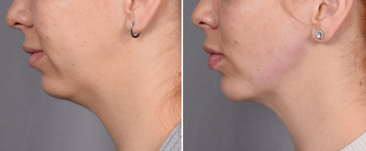 Chin Implant Before & After Gallery - Patient 382217 - Image 2