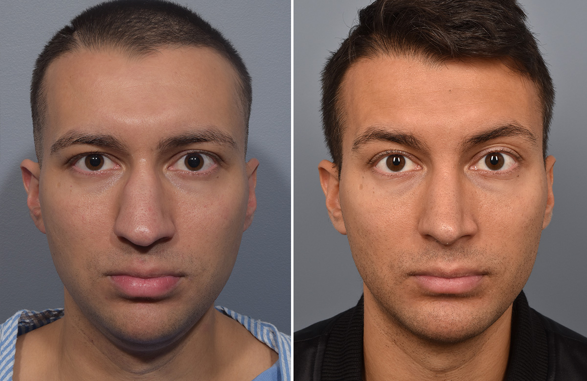 Chin Implant Before & After Gallery - Patient 726509 - Image 8