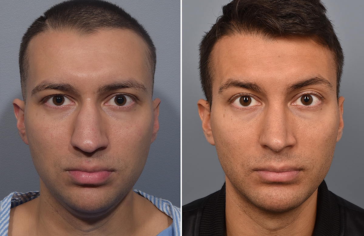 Chin Implant Before & After Gallery - Patient 726509 - Image 8