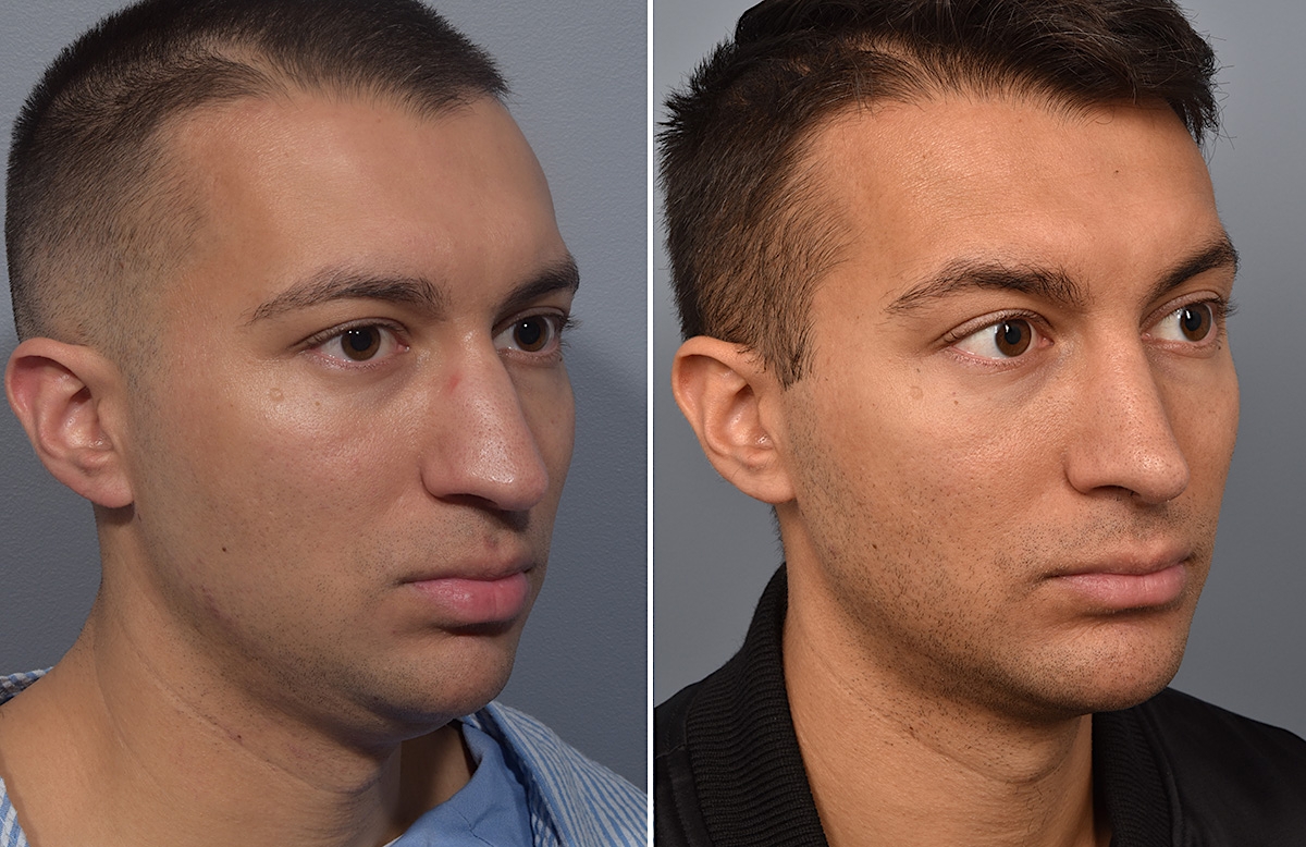Chin Implant Before & After Gallery - Patient 726509 - Image 9