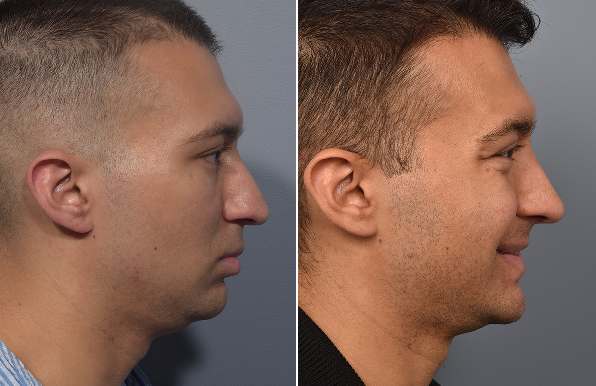 Chin Implant Before & After Gallery - Patient 726509 - Image 10