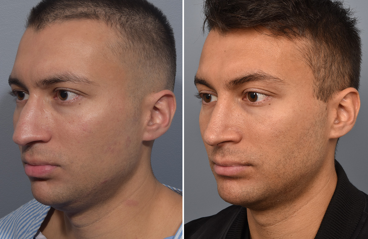 Chin Implant Before & After Gallery - Patient 726509 - Image 6