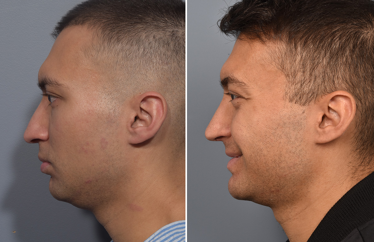 Chin Implant Before & After Gallery - Patient 726509 - Image 7