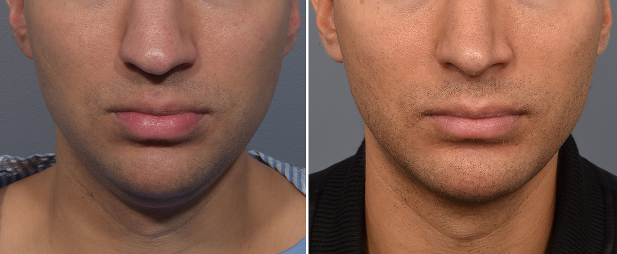 Chin Implant Before & After Gallery - Patient 726509 - Image 3